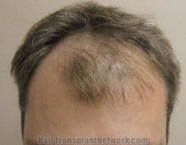 Hair Restoration Before & After Patient #1505