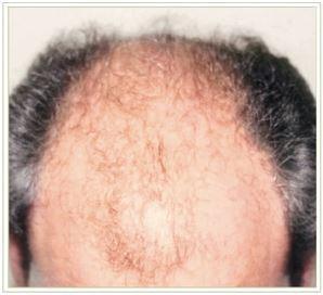 Hair Restoration Before & After Patient #1504