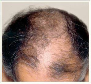 Hair Restoration Before & After Patient #1509