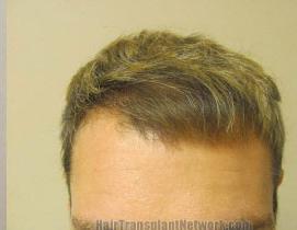 Hair Restoration Before & After Patient #1505