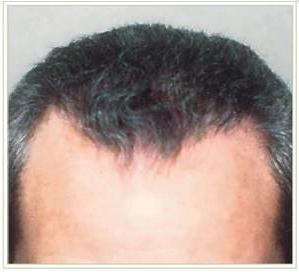 Hair Restoration Before & After Patient #1504