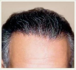 Hair Restoration Before & After Patient #1509